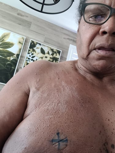 Customer photo review of Radiation Burn Cream for Radiation Therapy Patients