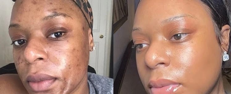 Customer photo review of 24k Golden Glow Essential Acne Kit