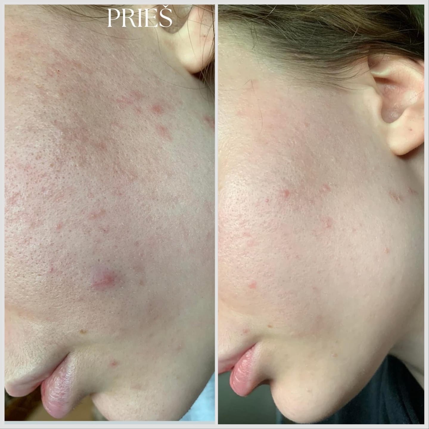 Customer photo review of Poras mažinantis ir sebumą reguliuojantis niacinamido serumas