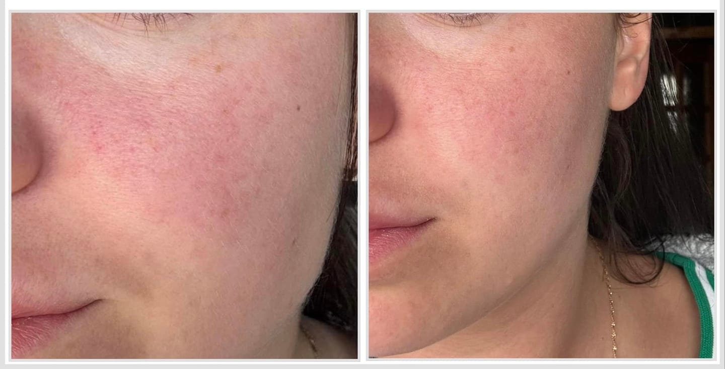 Customer photo review of Kremas su azelaino rūgštimi