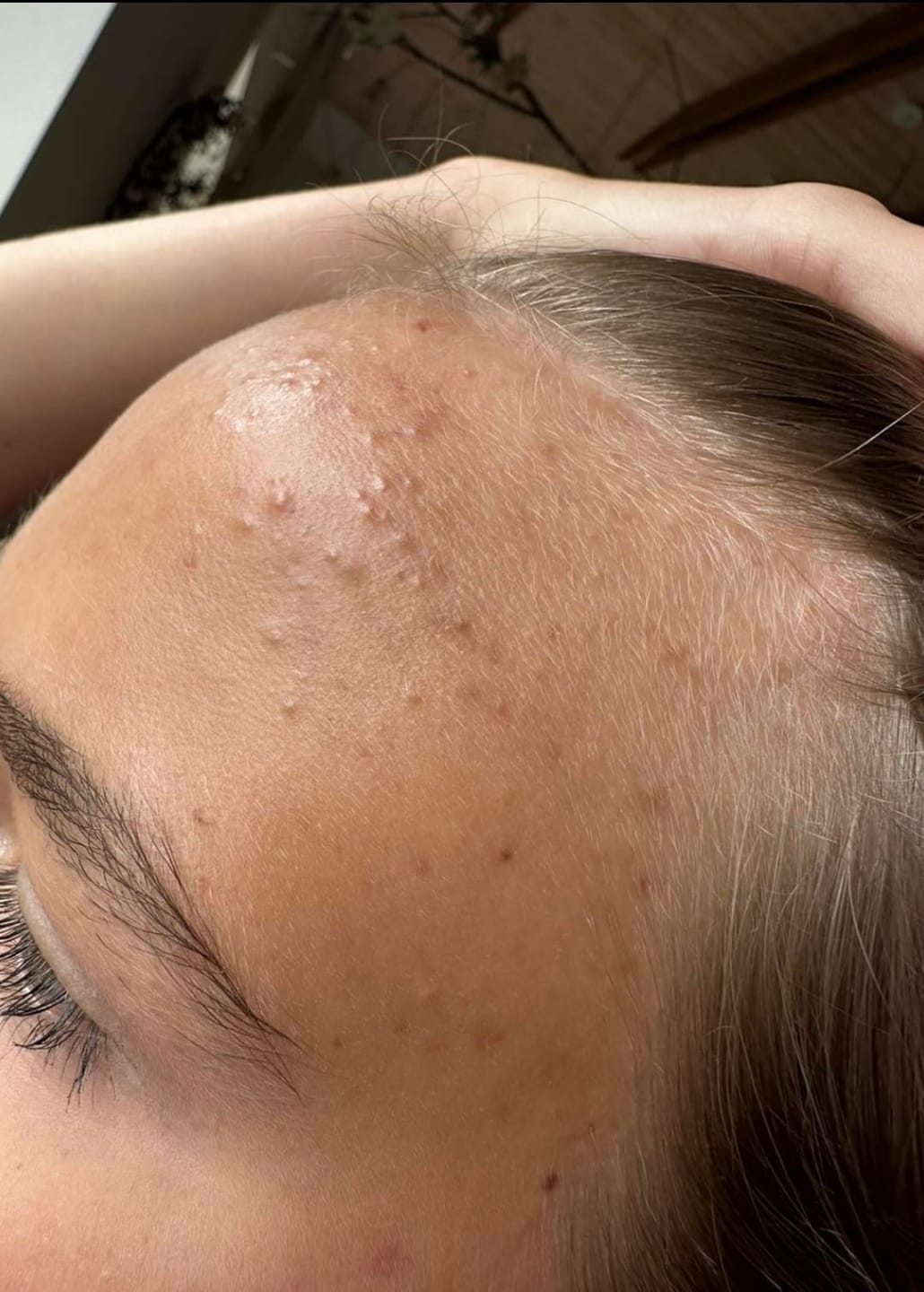Customer photo review of Rinkinys aknės pažeistai odai