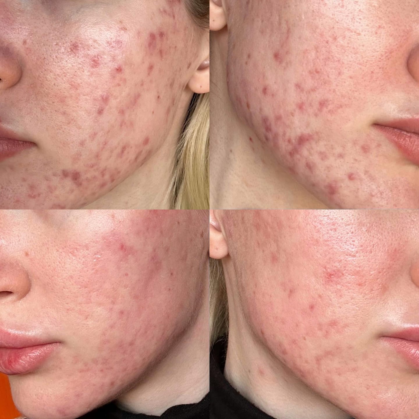 Customer photo review of Rinkinys aknės pažeistai odai