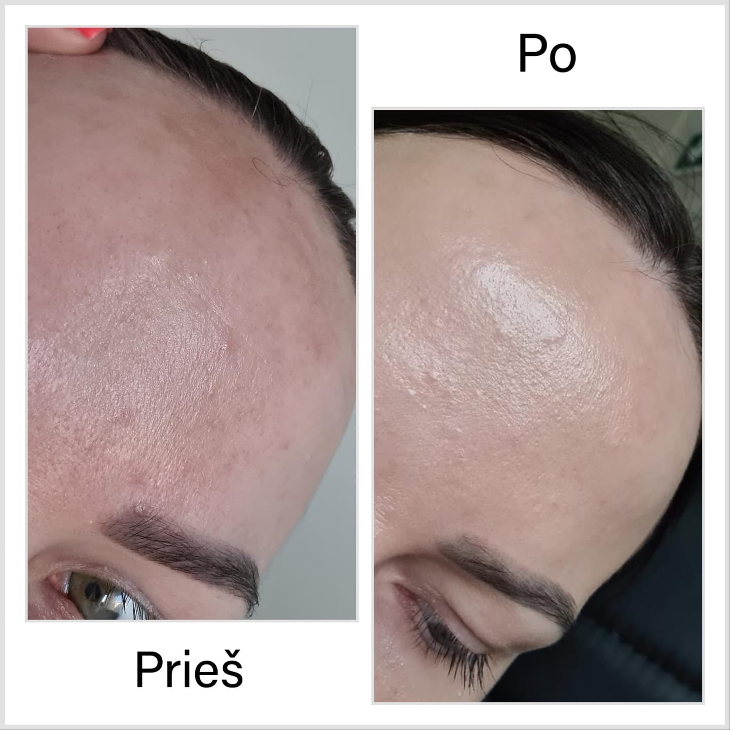 Customer photo review of Rinkinys aknės pažeistai odai