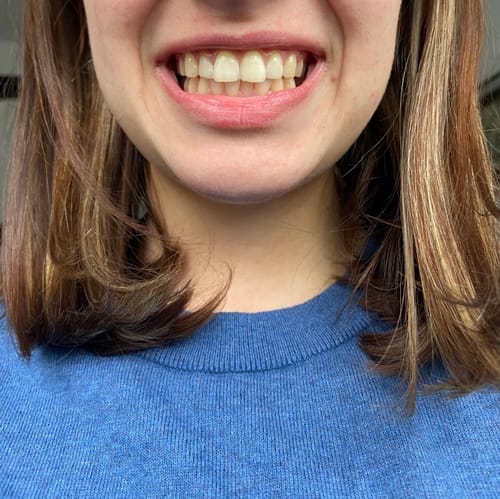 Customer photo review of Teeth Whitening Strips