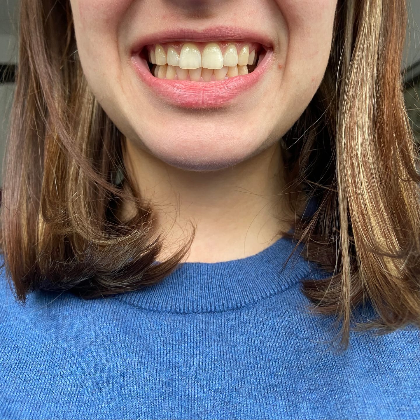 Customer photo review of Teeth Whitening Strips