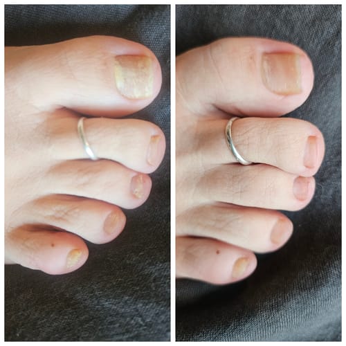 Customer photo review of Pentachom Antifungal Laser Program