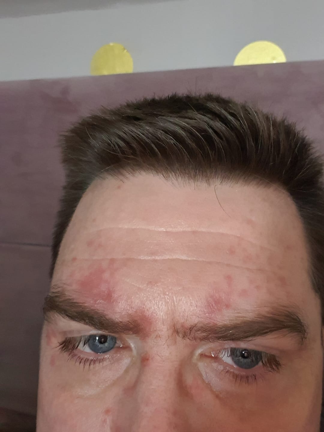 Customer photo review of Bioskin DermaSpray Intensive