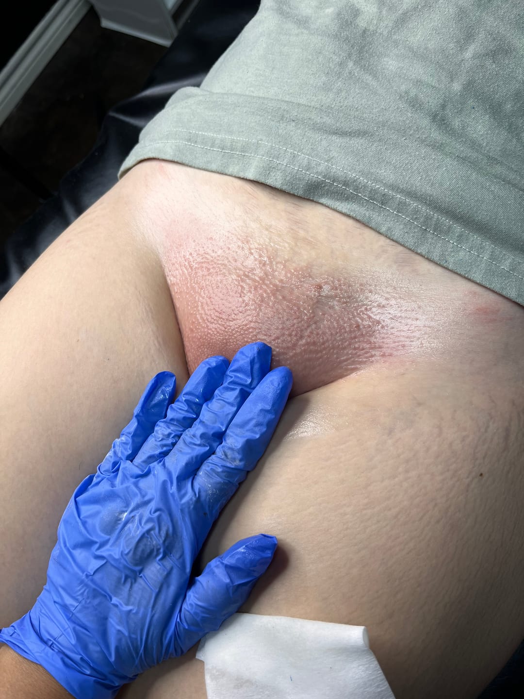 Customer photo review of Pre & Post Waxing Oils (PRO Bulk Sizes)