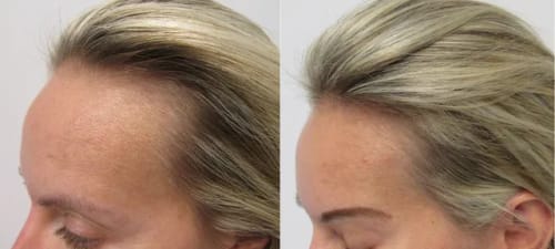 Customer photo review of The Naked Skin High Frequency Wand™