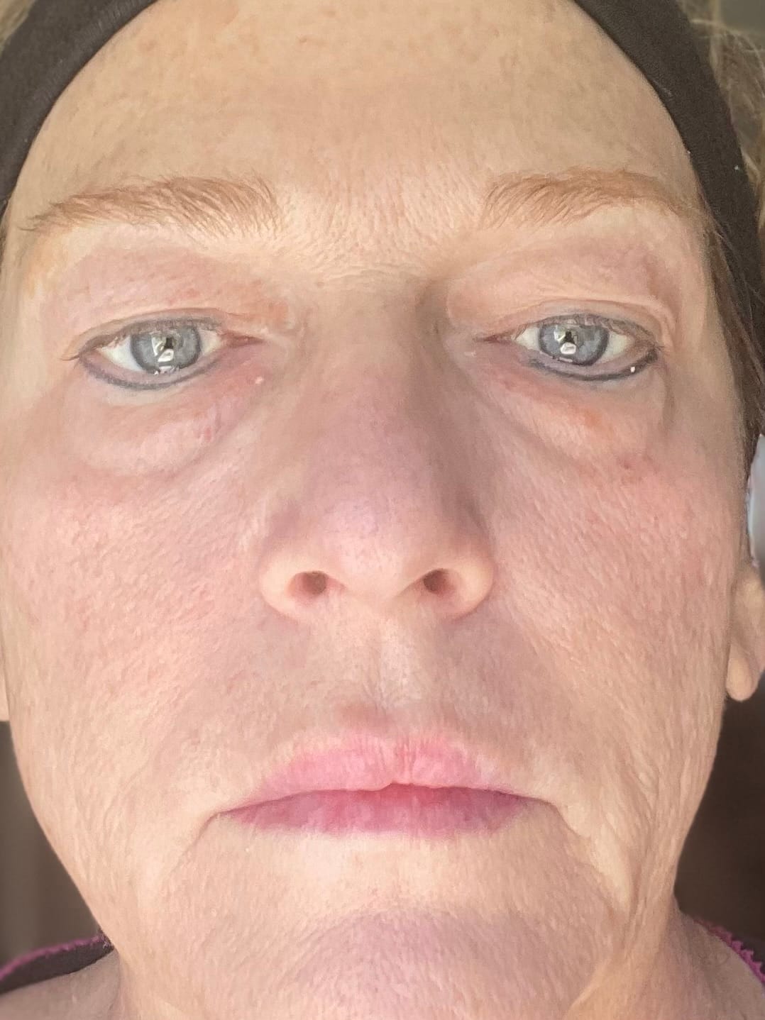 Customer photo review of Extra Strength Fading Kit