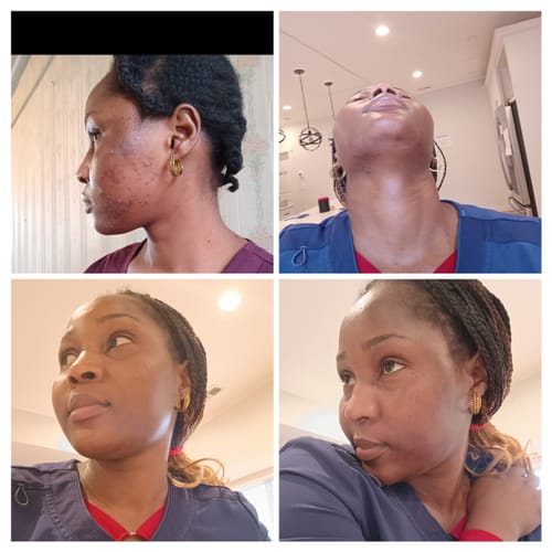 Customer photo review of Turmeric Glow wash for black spots,acne & glow