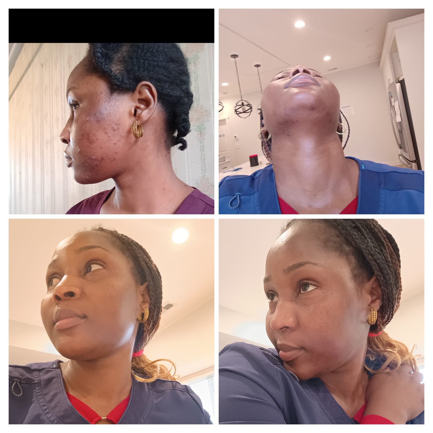 Customer photo review of Turmeric Glow wash for black spots,acne & glow