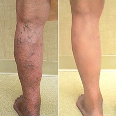 Customer photo review of LOVILDS™Varicose Veins Treatment Cream🔥(Limited Time Discount Last Day)