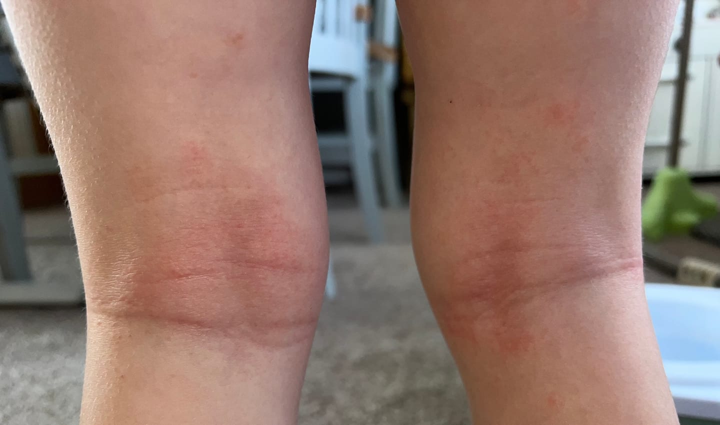 Customer photo review of Bioskin Junior Duo Pack (Free Outbreak Rescue Cream)