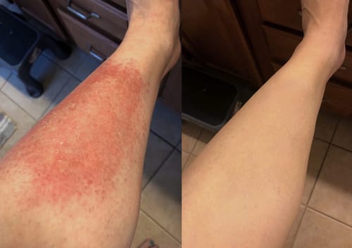 Customer photo review of 🐝🐝Bee Venom Mole and Wart Treatment Cream