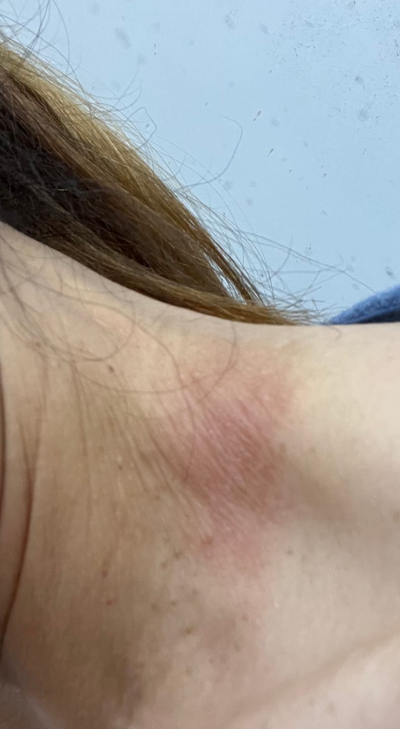 Customer photo review of Bioskin Duo Pack (Free Bioskin Zeoderm)