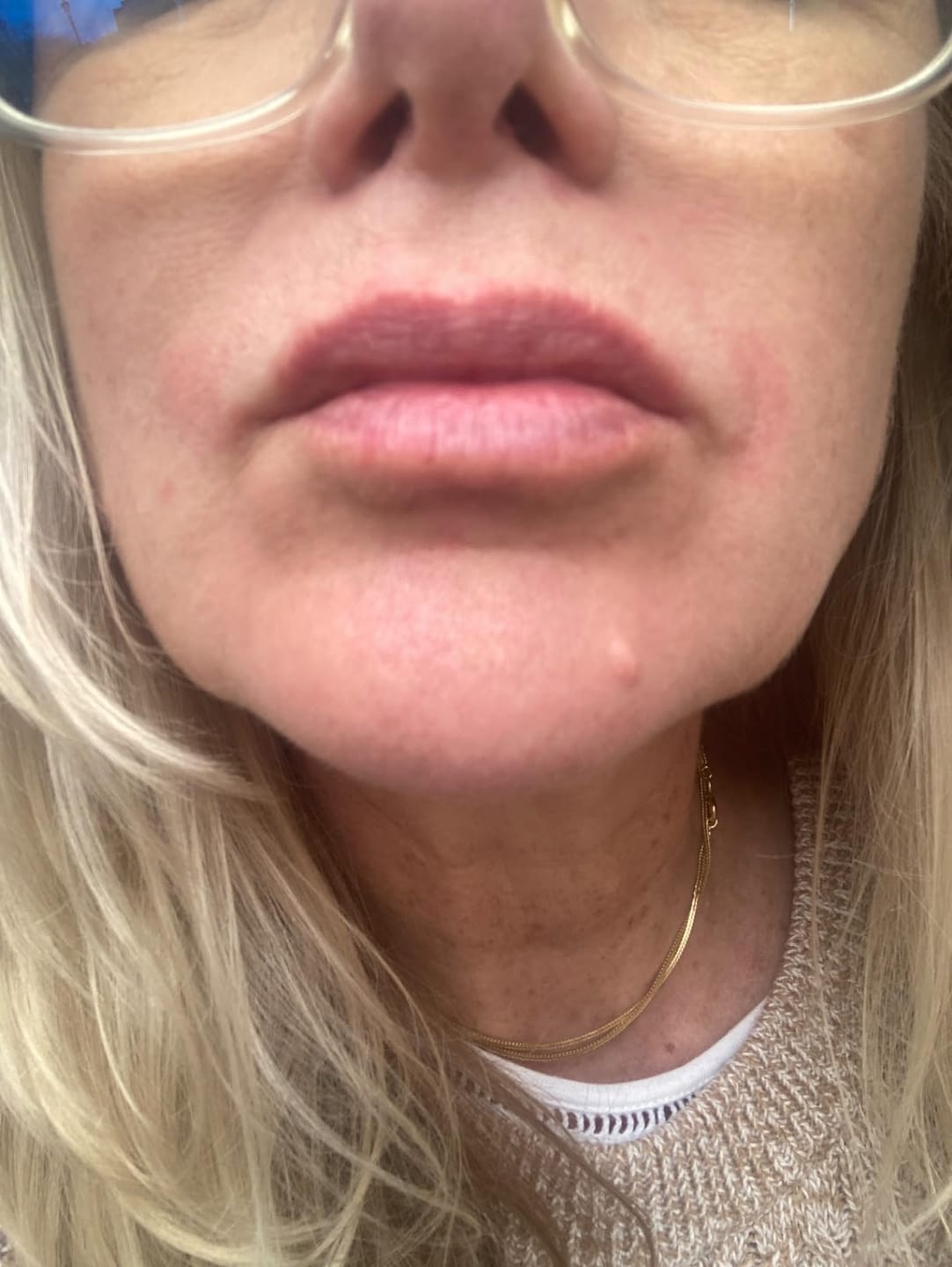 Customer photo review of Dr. Pen HydraPen H3 Newest Hydra Pen From Dr. Pen