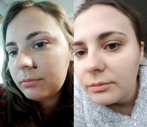 Customer photo review of 🐝🐝Bee Venom Mole and Wart Treatment Cream