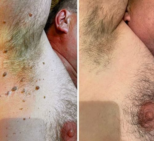 Customer photo review of 🐝🐝Bee Venom Mole and Wart Treatment Cream