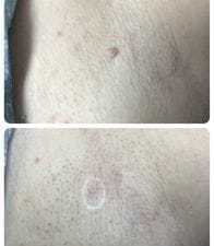 Customer photo review of 🐝🐝Bee Venom Mole and Wart Treatment Cream