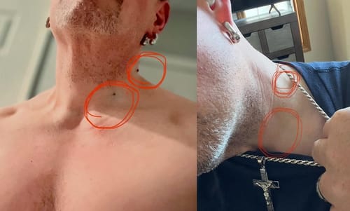 Customer photo review of 🐝🐝Bee Venom Mole and Wart Treatment Cream