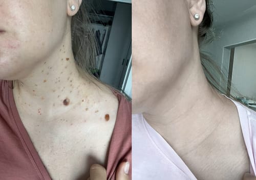 Customer photo review of 🐝🐝Bee Venom Mole and Wart Treatment Cream