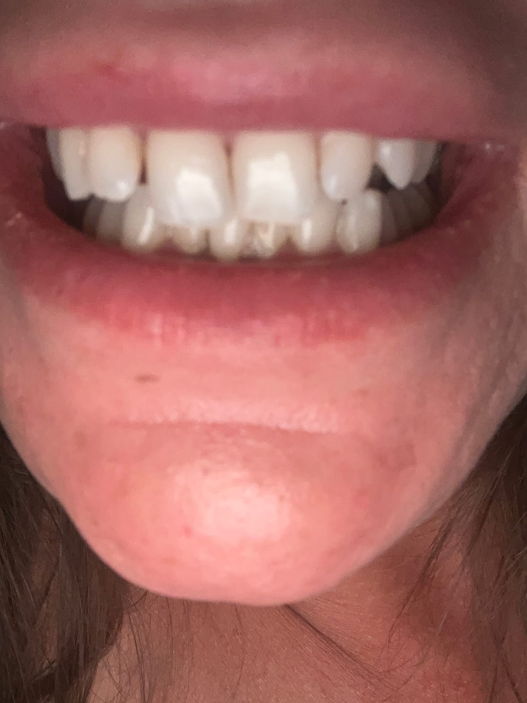Customer photo review of Pack Bandes : 2 Paquets Bandes Kauka Smile (sans peroxyde)