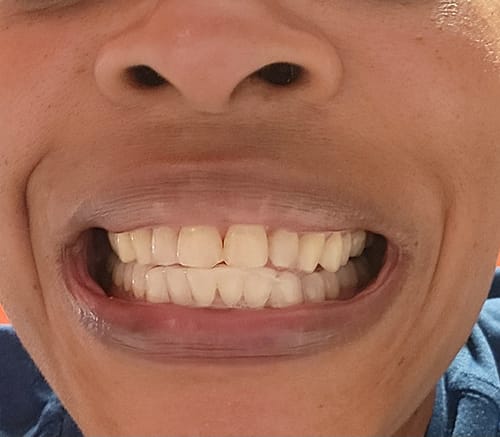 Customer photo review of Lower Teeth Retainer