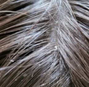 Customer photo review of ANTI DANDRUFF DEFENCE SHAMPOO