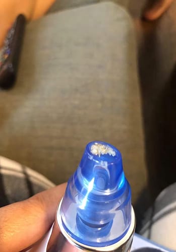 Customer photo review of Extracta™ - Blackheads Remover Vacuum