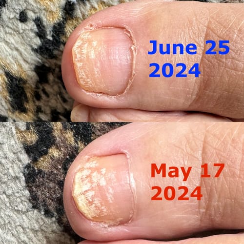 Customer photo review of Onychom - Antifungal Laser Device