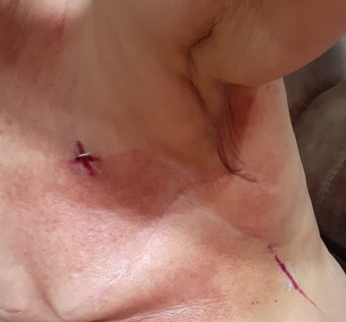 Customer photo review of Radiation Relief Cream – Unscented Burn Cream for Radiation Therapy