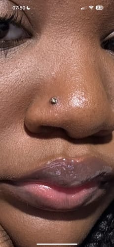 Customer photo review of Piercing Bump Treatment - Bump, Keloid & Scar Relief Oil