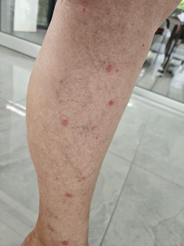 Customer photo review of Psoralyn - pikkelysömör elleni krém