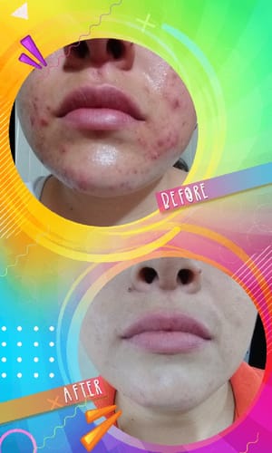 Customer photo review of OBY Pure Inositol | Myo Inositol y D-Chiro Inositol, Ácido Fólico, Hierro y Extracto Arándano