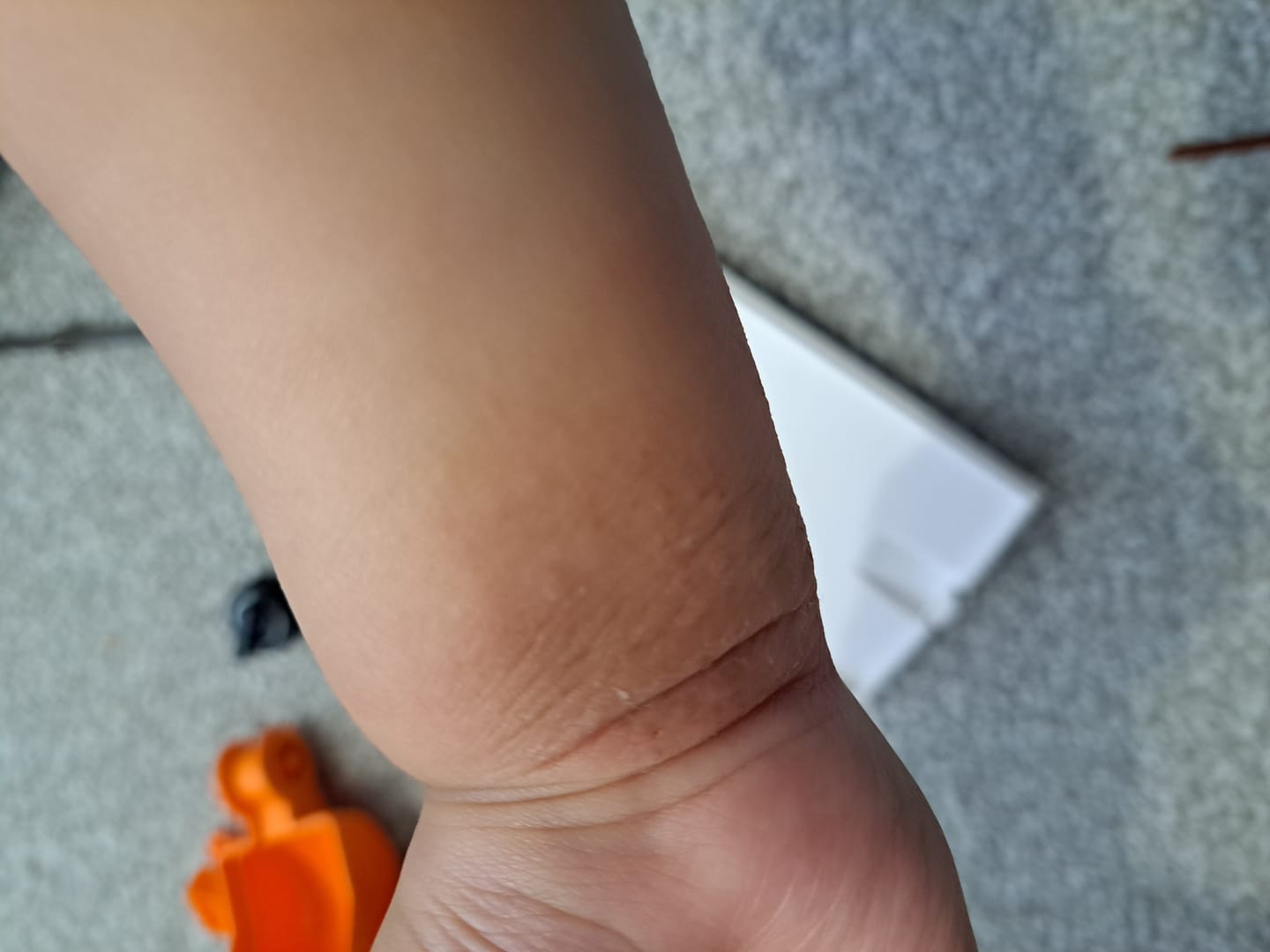 Customer photo review of Bioskin Junior Duo Pack (Free Outbreak Rescue Cream)