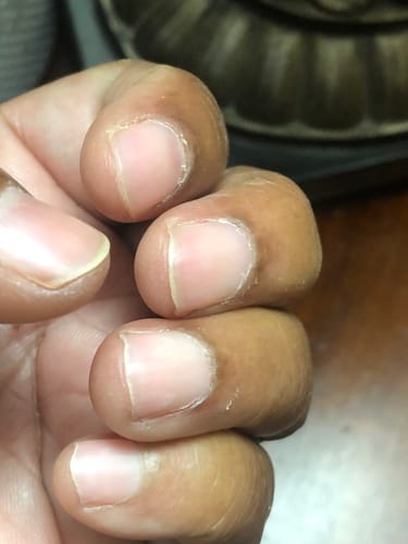 Customer photo review of Rocket Nail Fuel Nail Repair - Clear