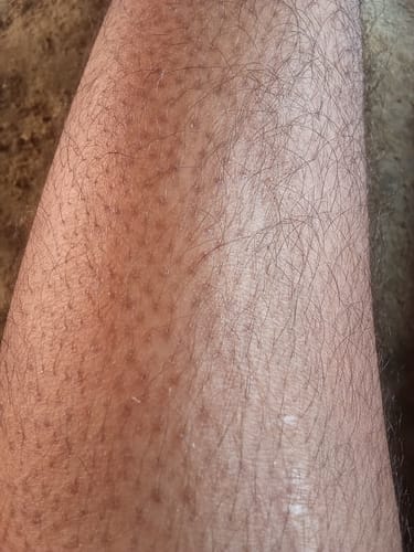 Customer photo review of Exfoliating Body Cream for Strawberry Skin & Pigmentation