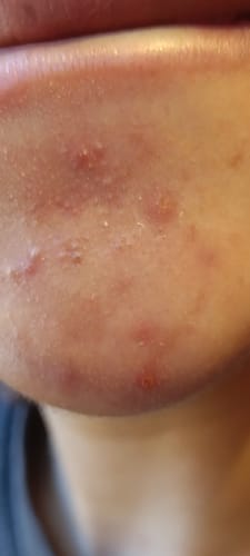 Customer photo review of Clear Spot Patch