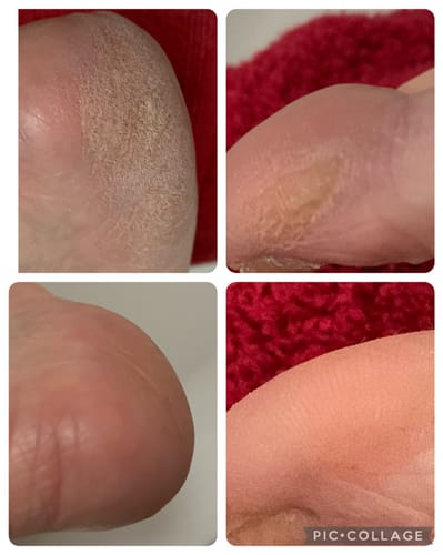 Customer photo review of LOVASKIN INSTANT FOOT PEEL Deluxe Kit - Less than 3.20 per treatment