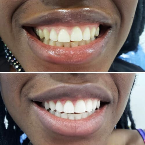 Customer photo review of Polar MD Teeth Whitening Kit