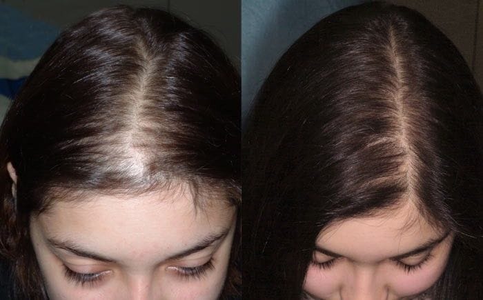 Customer photo review of Rosemary Scalp Treatment