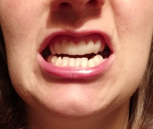 Customer photo review of Teeth-Veneer 2.0