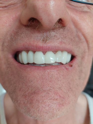 Customer photo review of Teeth-Veneer 2.0