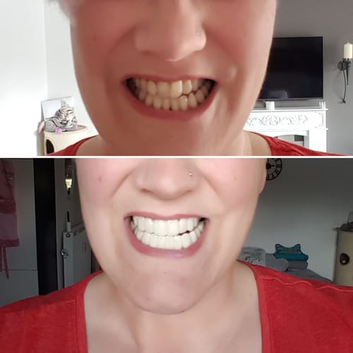 Customer photo review of Teeth-Veneer 2.0
