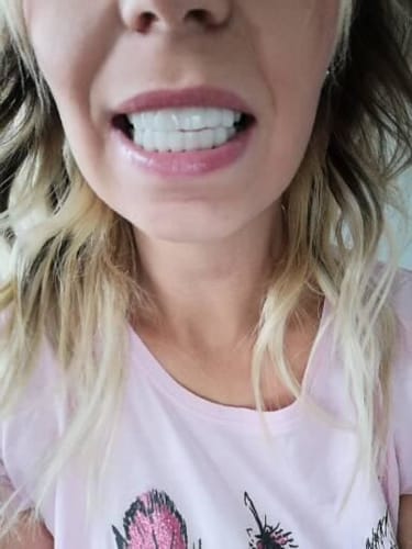 Customer photo review of Teeth-Veneer 2.0