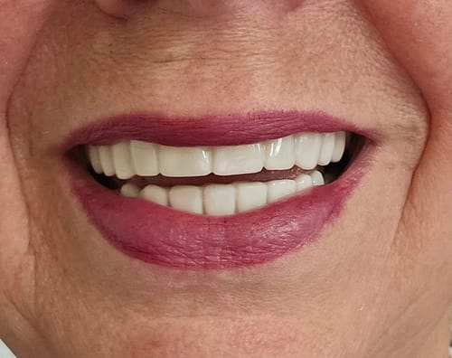 Customer photo review of Teeth-Veneer 2.0