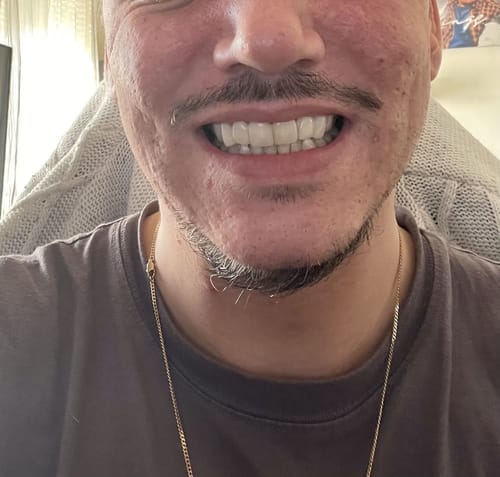 Customer photo review of Teeth-Veneer 2.0