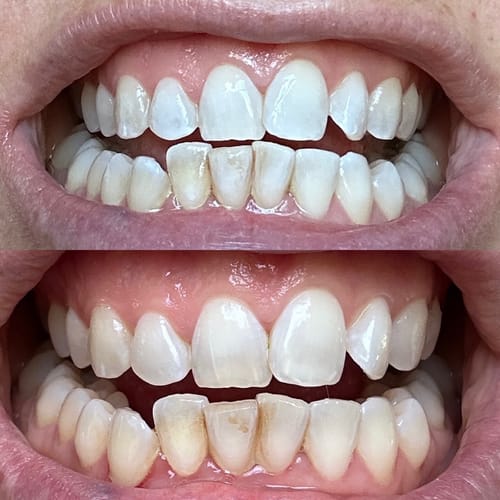 Customer photo review of Teeth Whitening Strips