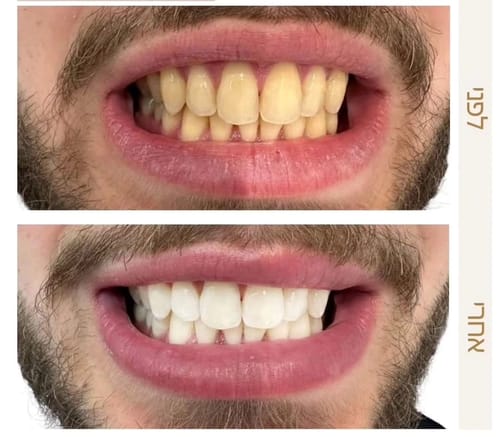 Customer photo review of משחה להלבנת שיניים - smilekit